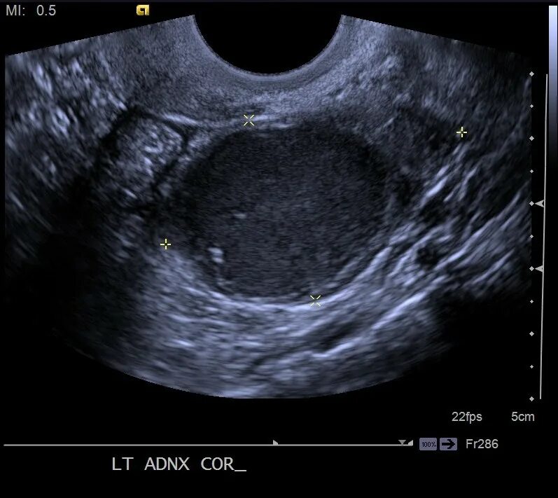Эндометриоидная киста яичника эндометриоидная киста. Эндометриоидная киста на УЗИ. Эндометриоз виден на узи