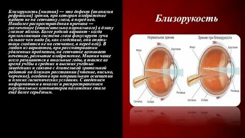 Миопия средней степени h 52.1