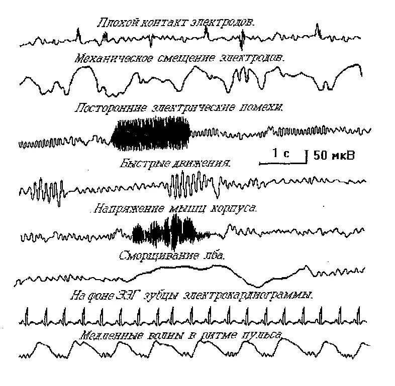 Плохое ээг. Артефакты ЭМГ при ЭЭГ. Артефакт ЭКГ на ЭЭГ. Артефакты ЭЭГ миограммы. ЭЭГ волны патологические.