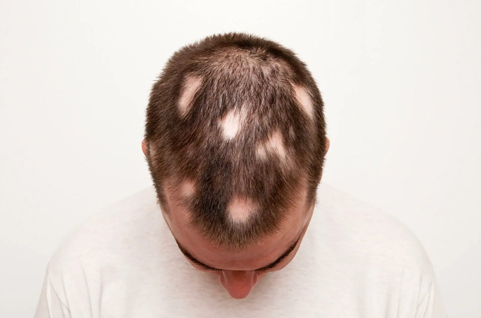 Болезненные волосы. Очаговая алопеция (alopecia Areata). Очаговая (гнездная) алопеция. Гнездная алопеция офиазис.
