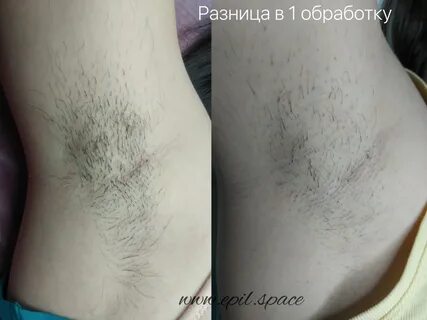 Электроэпиляция нитью