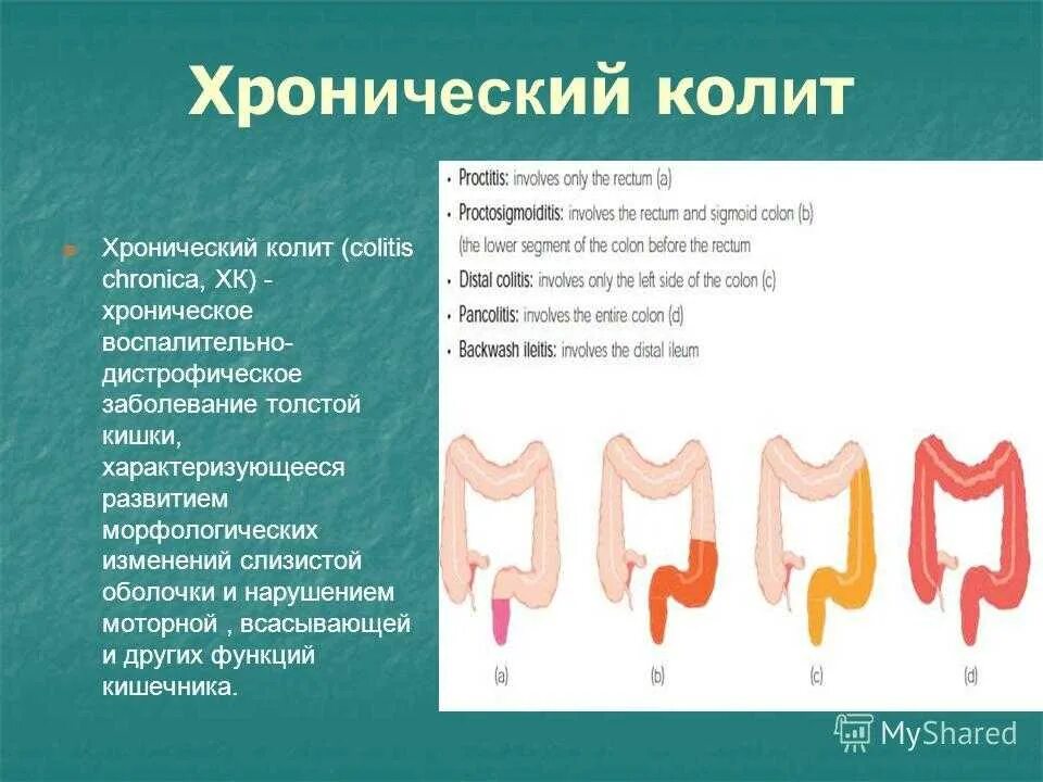 Колит слабость. Хронический колит кишечника. Хронический лит кишечника. Хронический колит симптомы. Хронический колит кишечника симптомы.