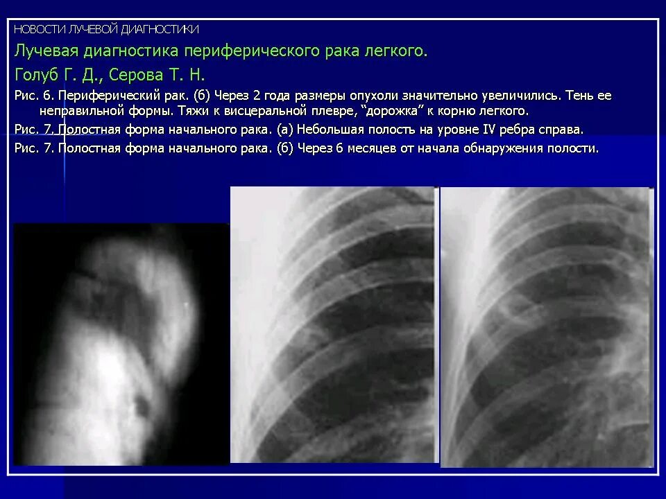 Лучевые заболевания легких. Периферическая опухоль легкого. Периферический c-r левого легкого. Лучевая диагностика. Рентгенодиагностика заболеваний легких.