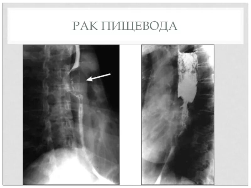 Рак пищевода степени. Плоскоклеточная карцинома пищевода. Инородные тела пищевода. Эзофагоскопия инородное тело пищевода.