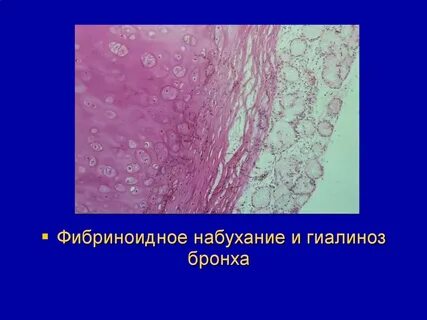 Фибриноид