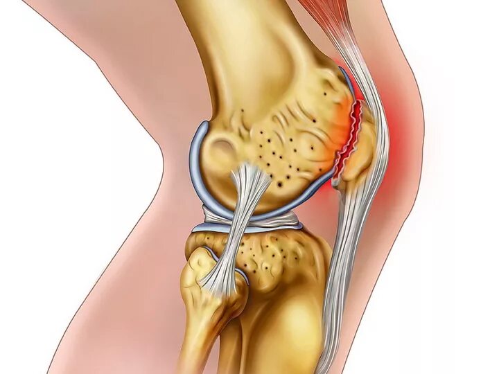 Разрыв медиальной. Разрыв мениска коленного. Внутренний менисцит коленного сустава. Мениск коленной чашечки что это такое.