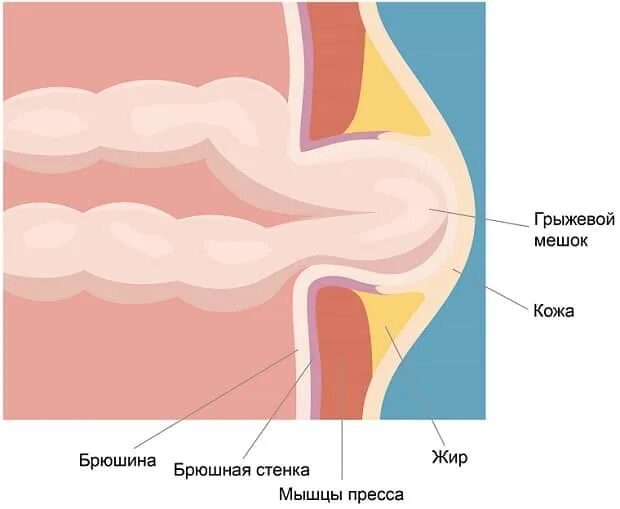 Пупочная грыжа что можно кушать. Пупочное кольцо расширено.