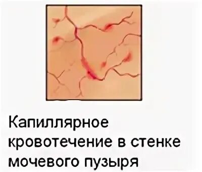 Цистит интерстициальный симптомы у женщин и лечение. Капиллярное кровотечение. Интерстициальный цистит цистоскопия. Интерстициальный нефрит. Посткоитальный синдром.