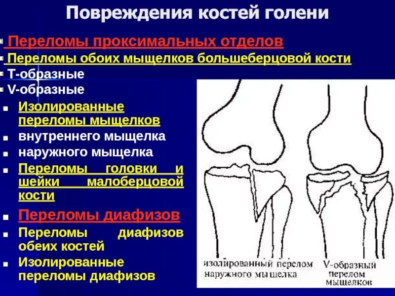 Переломы мыщелков большеберцовой кости классификация. Перелом проксимального метафиза большеберцовой кости. Перелом проксимального отдела большеберцовой кости. Вколоченный перелом малоберцовой кости.