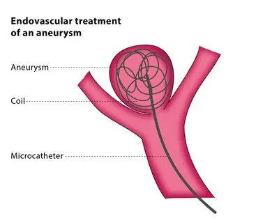 Aneurysm перевод