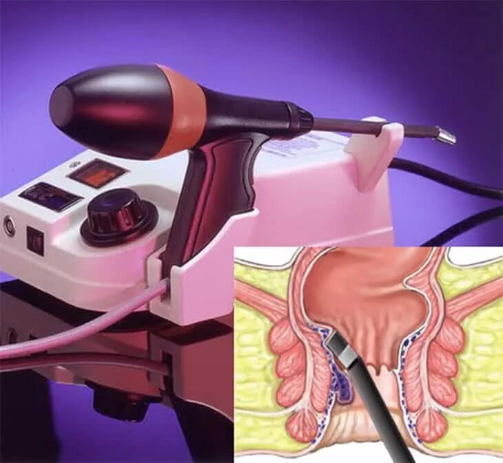 Операция полипы сколько стоит. Лазерная коагуляция геморроидальных узлов. Инфракрасная коагуляция геморроидальных узлов. Инфракрасная фотокоагуляция геморроя. Инфракрасное фотокоагуляция геморроя лазером.