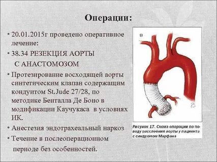 Изменение аорты