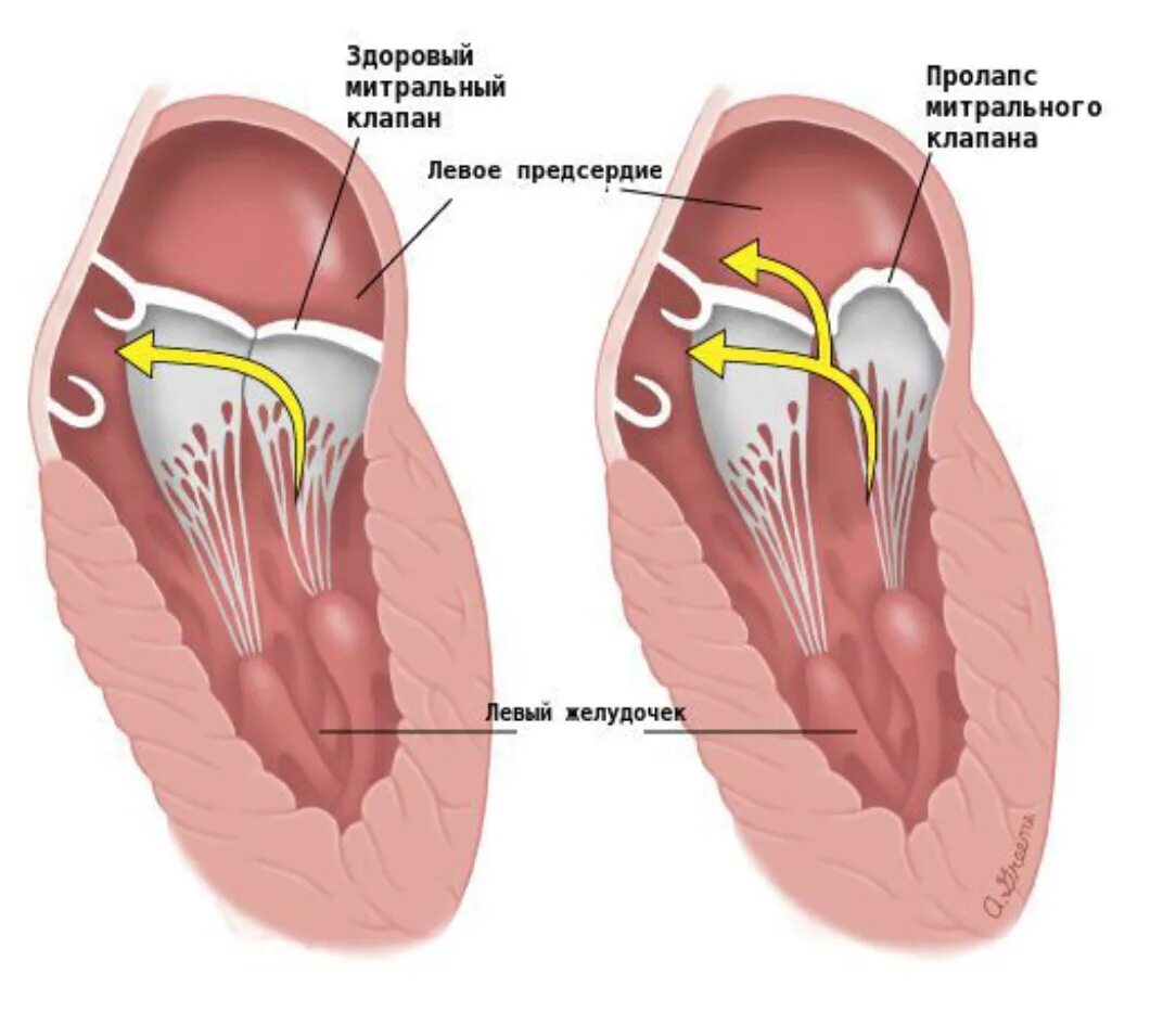 Наличие хорды у человека. Пролапс митрального клапана. Пролапс митрального клапана клапана. Пролапс митрального клапана хорда. ПРОЛАБ сметрального клапана.