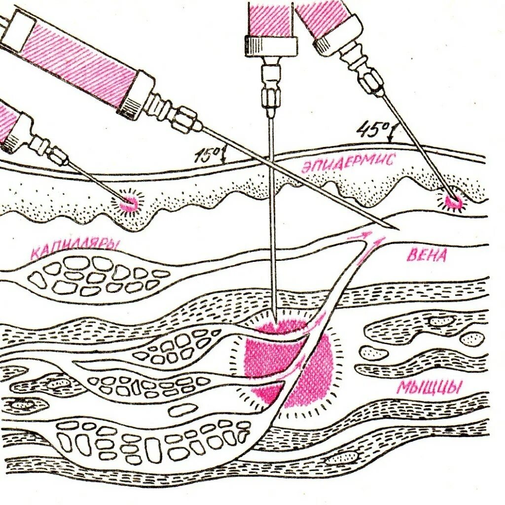 Введения иглы при проведении внутримышечной инъекции. Техника введения инъекции в ягодицу. Схема введения внутримышечных уколов. Схема введения внутримышечной инъекции.