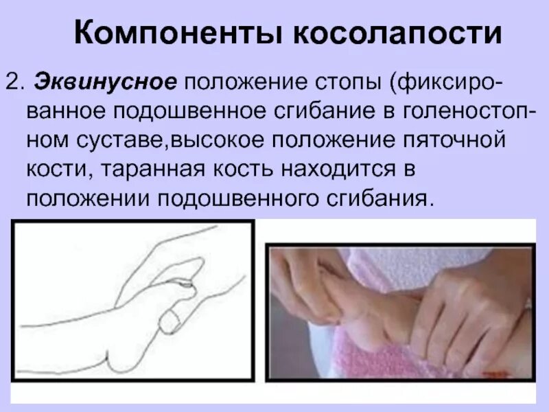 Положение подошвенного сгибания. Эквинусное положение стопы. подошвенное сгибание в голеностопном суставе. компоненты косолапости. положение подошвенного сгибания стопы.