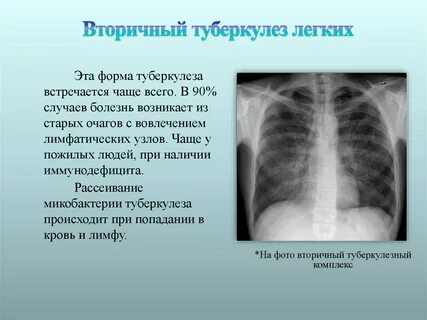 Туберкулез легких типы