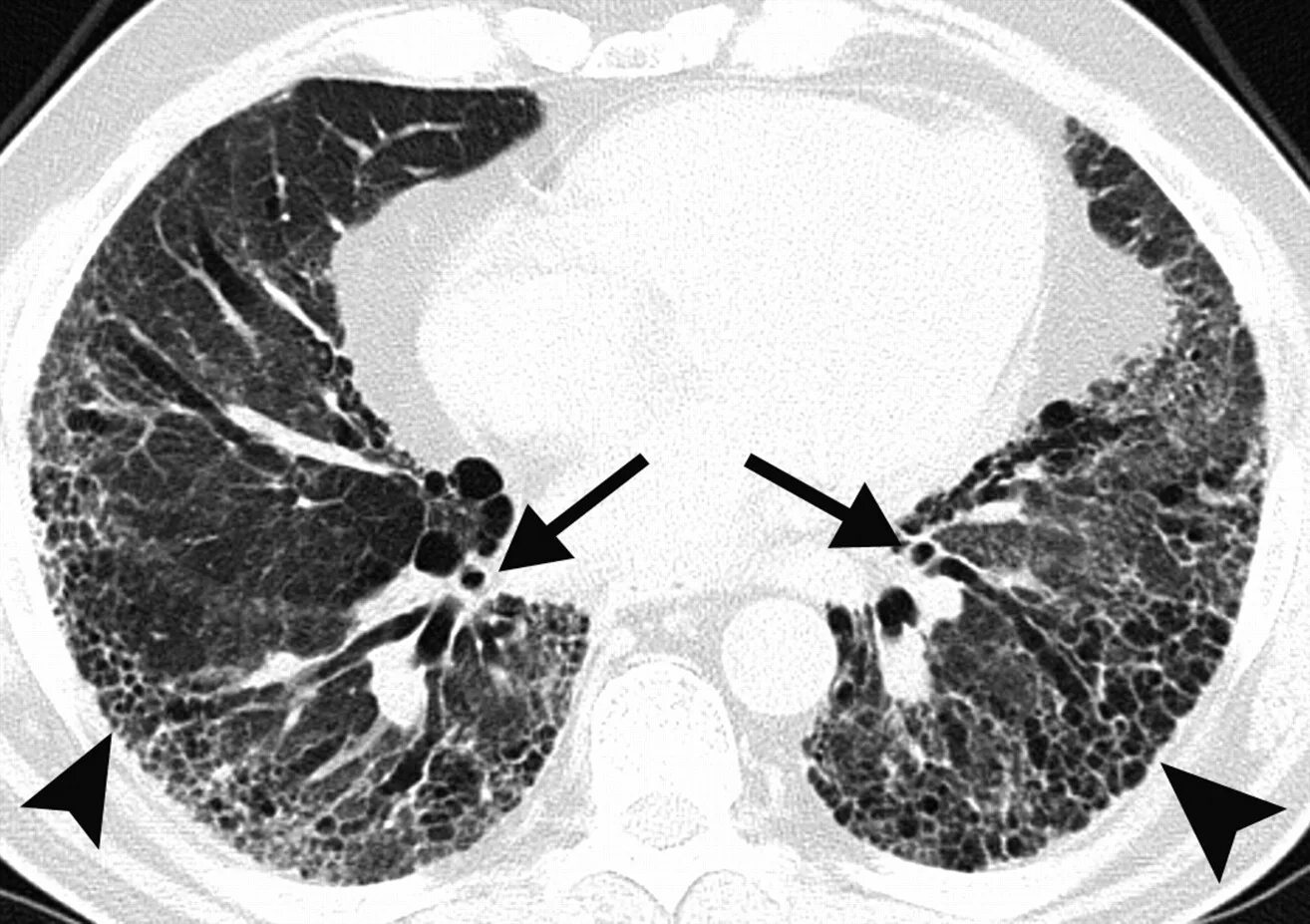 Интерстициальные изменения в легких на кт. Интерстициальные изменения в легких на кт. Кт легких при интерстициальные изменения. Поражение легких при ревматоидном артрите кт. Интерстициальные изменения в легких на кт.