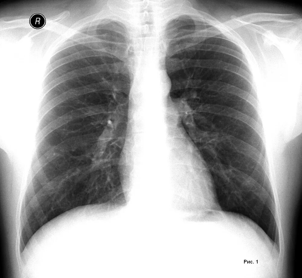 Какие легкие в норме. Рентген грудной клетки норма. Рентген грудной клетки и флюорография. Рентгенография органов грудной клетки норма. Рентгенограмма грудной клетки норма.