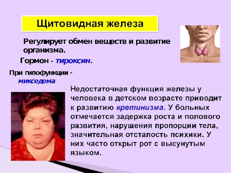 Гипофункция щитовидной железы. При недостаточной функции щитовидной железы развивается. Заболевания при гипофункции щитовидной железы. Недостаточная функция щитовидной железы приводит. При гипофункции железы у человека развивается