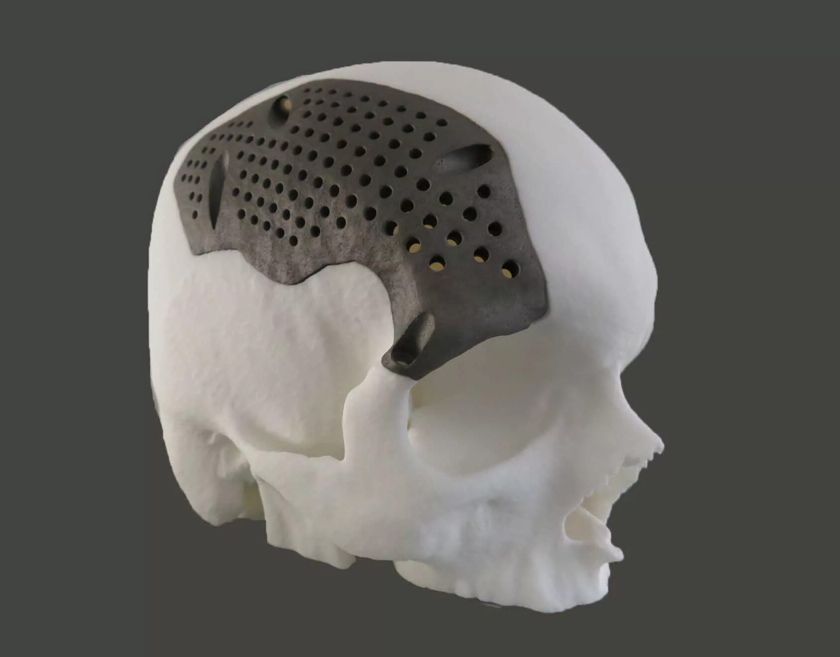 Протез кости. Dmls 3d печать. 3d печать slm. импланты 3д печать. аддитивные технологии в медицине протезы.