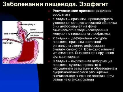 Эзофагит причины симптомы