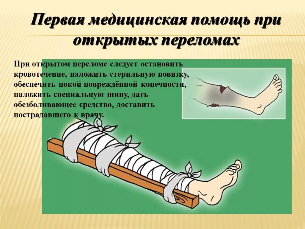 Как оказать первую медицинскую помощь при переломе. ПМП при открытом переломе. Последовательность оказания ПМП при открытом переломе:. Первая помощь при открытом переломе с артериальным кровотечением. Как оказать первую медицинскую помощь при открытых переломах?.