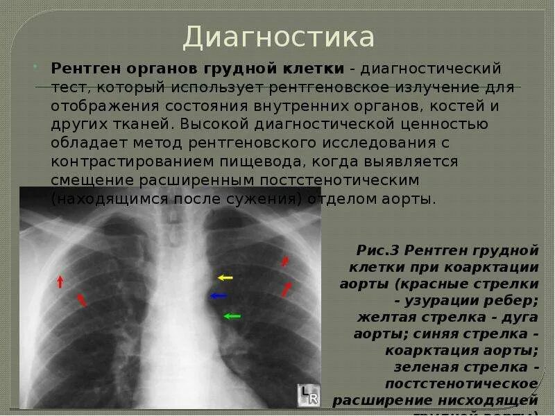 Что такое аортосклероз легких и как лечить