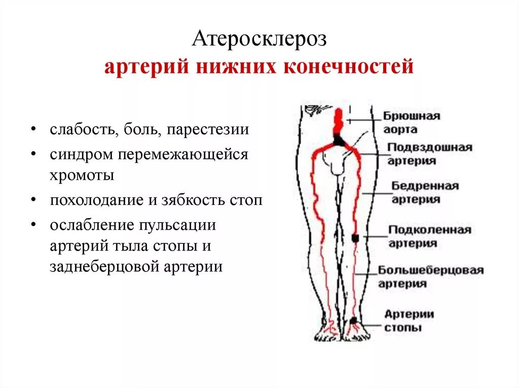 Признаки атеросклеротического поражения артерии. Основные симптомы атеросклероза артерий нижних конечностей. Клинические проявления атеросклероза сосудов нижних конечностей. Атеросклероз сосудов нижних конечностей основные жалобы. Сосудов нижней конечности атеросклероза клиника симптомы.