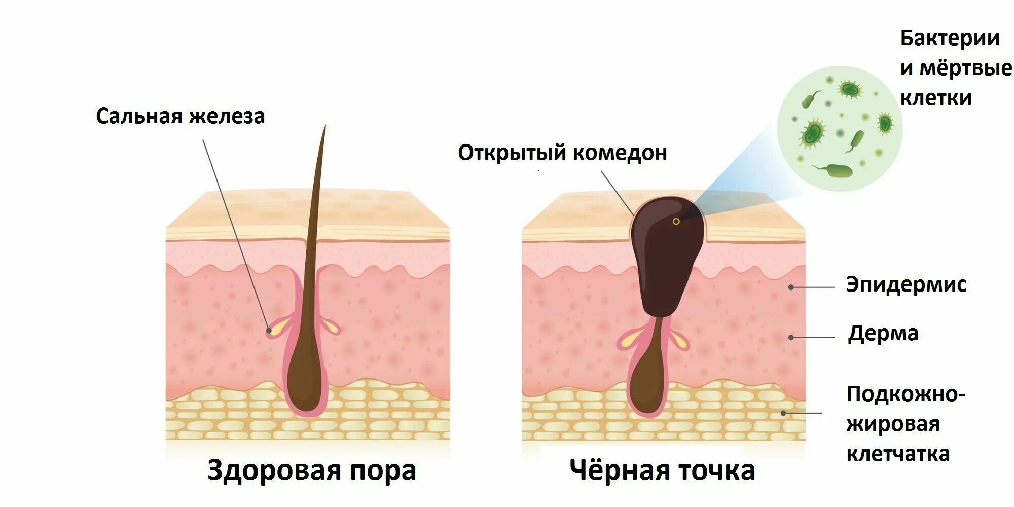 Причина пор