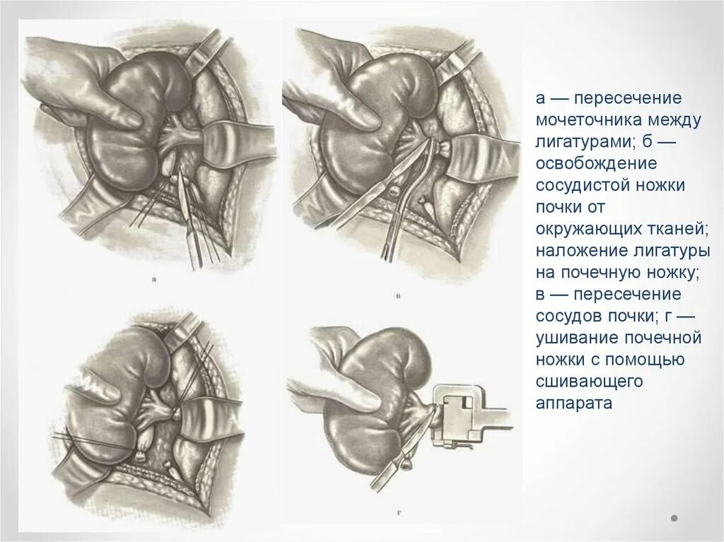 Резекция почки что это. Нефрэктомия резекция почки. Наложение лигатуры на сосуд.