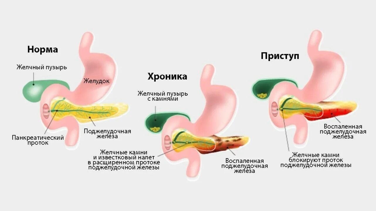 Болит поджелудочная что делать. Поджелудочная железа симптомы. Острый идиопатический панкреатит. Панкреатит симптомы у мужчин.