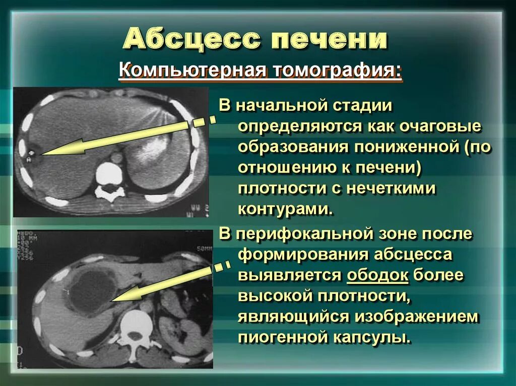 Амебный абсцесс печени кт. Солитарный абсцесс печени. Пиогенный абсцесс печени кт. Кистозное образование печени