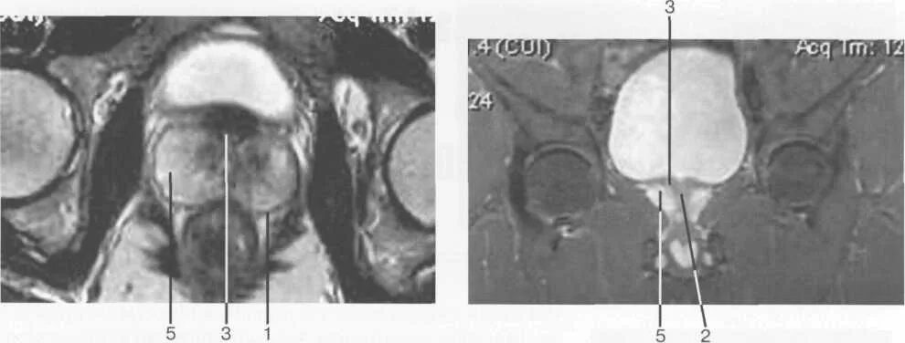 Предстательная железа кт анатомия. Предстательная железа кт норма. Мрт предстательной железы норма. Аденома предстательной железы мрт. Аденома простаты мрт