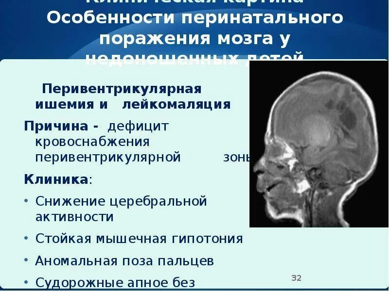 Поражение головного мозга последствия. Ишемия головного мозга у новорожденного. Перивентрикулярная ишемия у новорожденного. Перивентрикулярная ишемия головного мозга. Отек головного мозга у новорожденного.