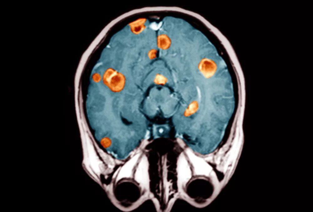 Метастазы в мозг прогноз. Метастазы головного мозга кт. Опухоль головного мозга метастазы. ПЭТ кт метастазы в головной мозг.
