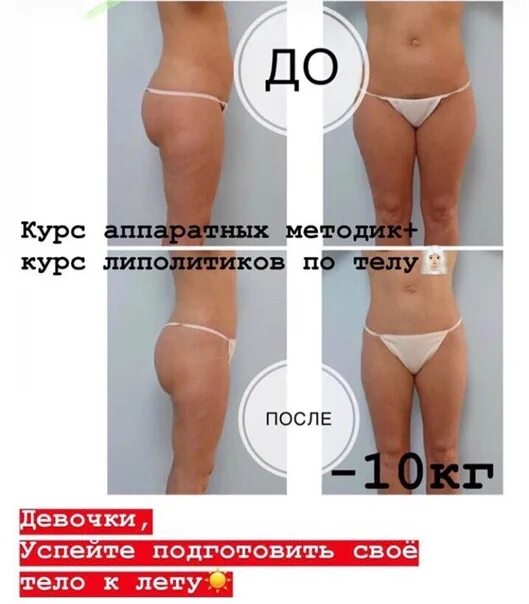 Через сколько эффект от липолитиков. Введение липолитиков в бедра. липолитики для коррекции фигуры.