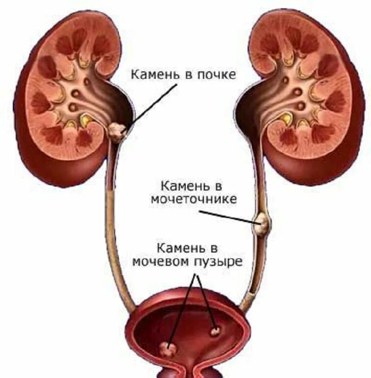 Локализация камней в мочевых путях. Камни мочевыводящих путей.