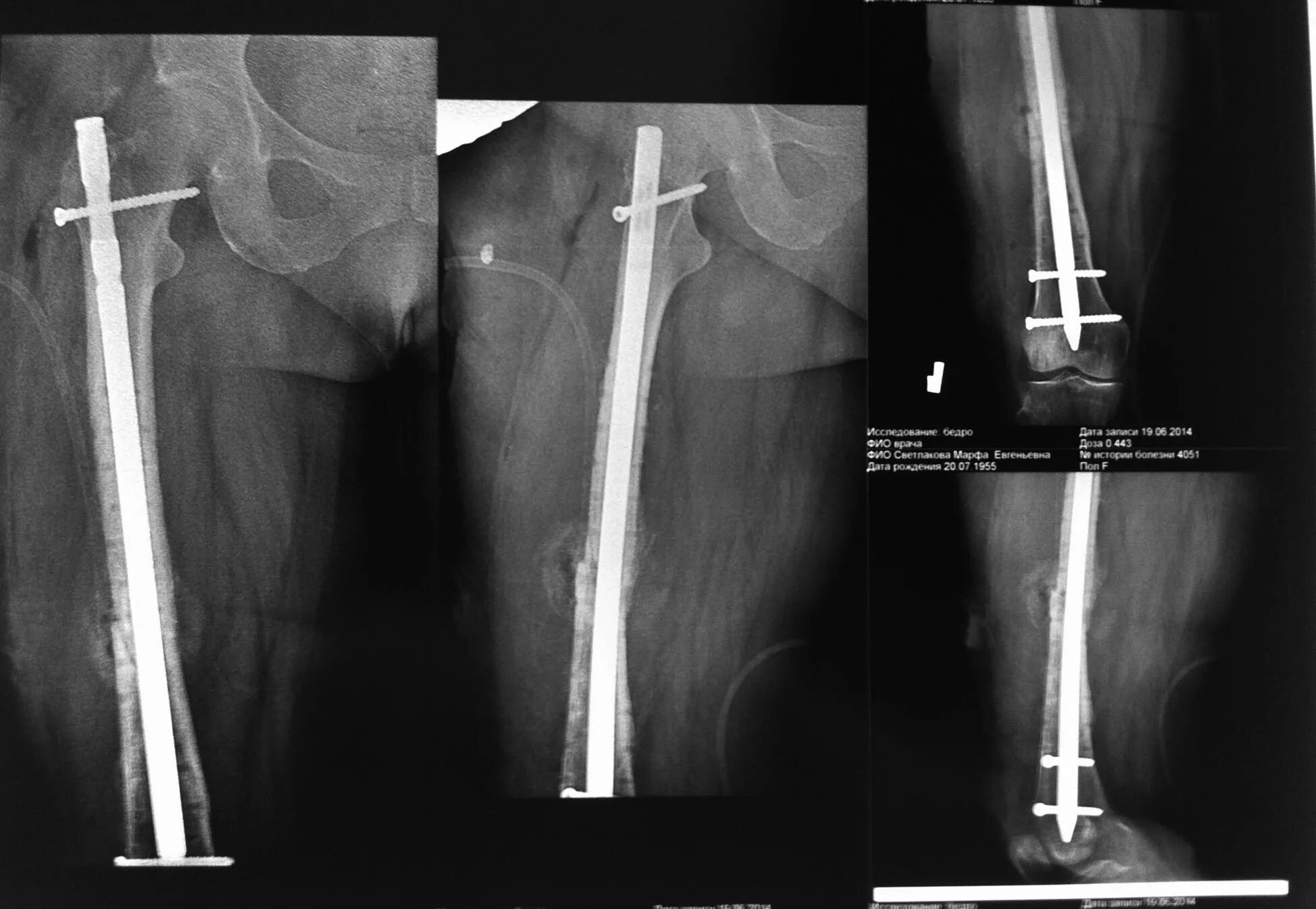 чрезвертельный перелом остеосинтез. чрезвертельный перелом остеосинтез. перелом диафиза бедренной кости рентген. повторный перелом бедра. повторный перелом бедра.