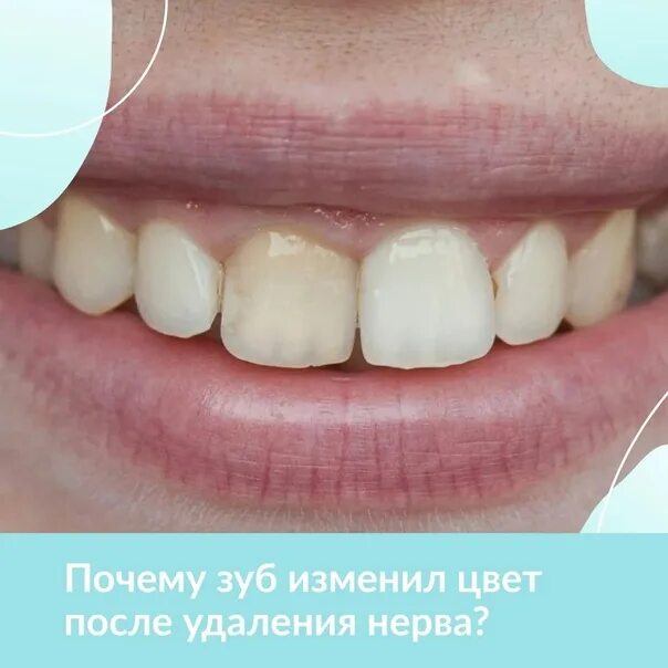 Ли зуб после удаления нерва. Зуб без нерва потемнел. кончики передних зубов темнеют.