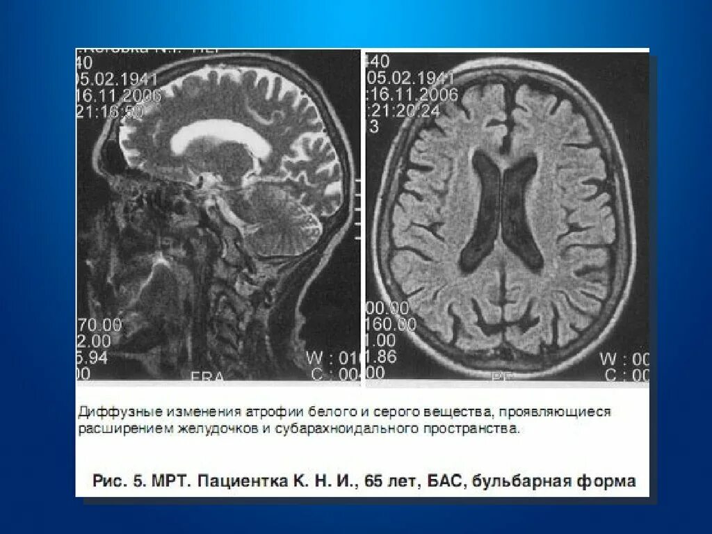 Атрофия головного мозга 1. Мрт при боковом амиотрофическом склерозе. Мрт спинного мозга при бас. Мозг на мрт при боковом амиотрофическом склерозе. Боковой амиотрофический склероз мрт спинного мозга.