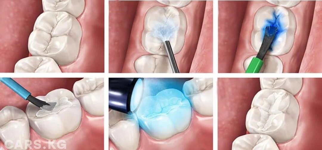 Через сколько можно кушать после лечения зуба. Пломба световой полимеризации. Пломба композита светоотверждаемого. Пломбы фотоотверждаемые композиты. Световая пломба композит.