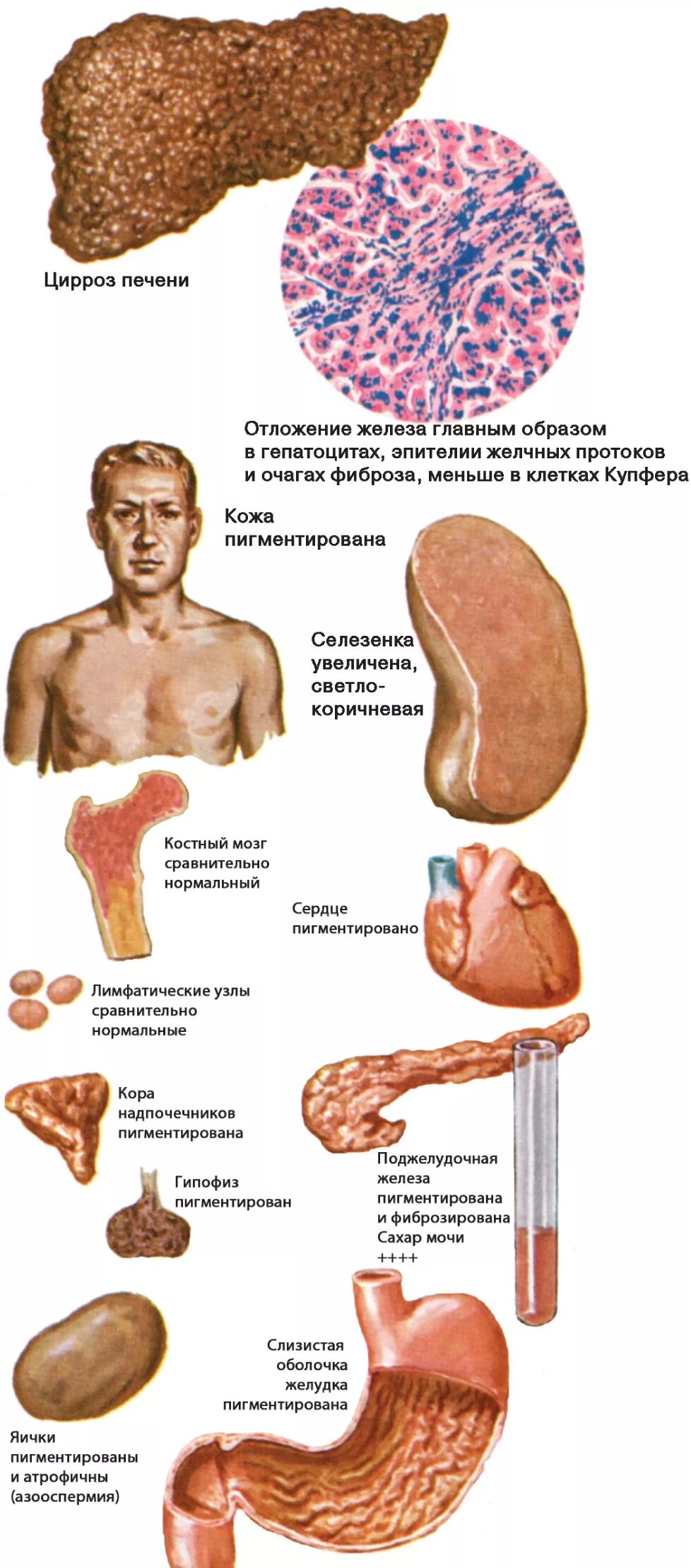 Гемохроматоз признаки. Стадии поражения цирроза печени. гемохроматоз клинические проявления.