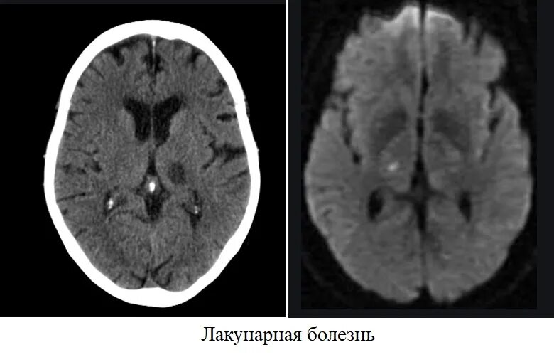 Постишемические кисты мозга. Лакунарная киста головного мозга на кт. Лакунарные кисты в головном мозге мрт. Лакунарный инсульт мрт. Эпидермоидная киста головного мозга мрт.