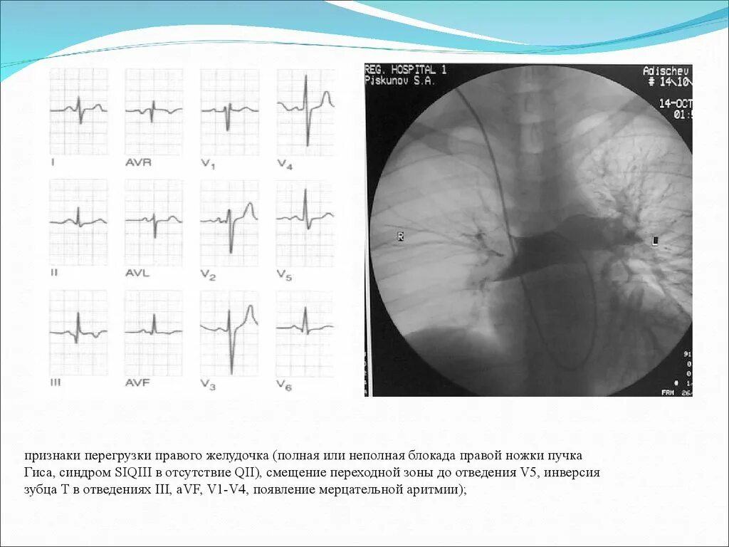 Блокада правой ножки желудочка. Признаки перегрузки правого желудочка. Неполная блокада правой ножки пучка Гиса. III AVF отведения полная блокада правой ножки пучка. Блокада правой ножки и гипертрофия правого желудочка.