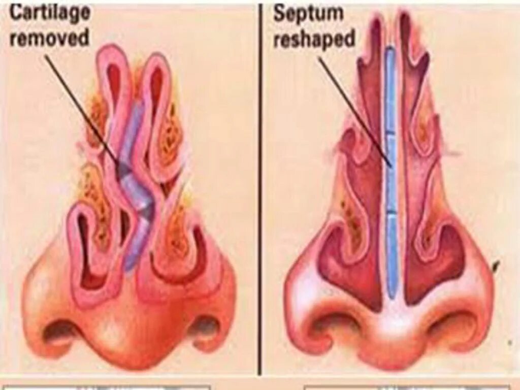 Искривление носовой перегородки шип. Септопластика носовой перегородки. Кривая перегородка носа операция. Искривление перегородки. Септопластика искривление носовой перегородки.