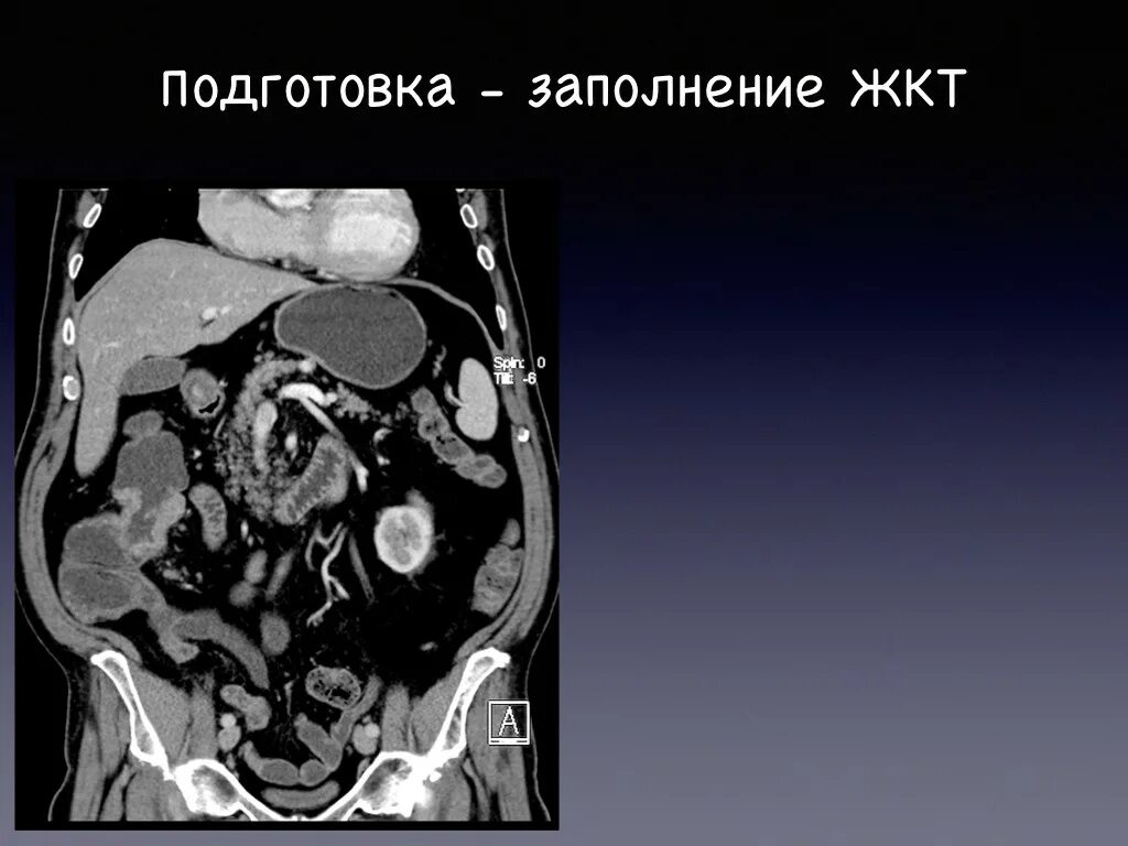 Питание перед мрт. Кт брюшной полости (контрастирование. Кт органов брюшной полости с контрастированием. Мрт органов брюшной полости с контрастированием. Кт брюшной полости и забрюшинного пространства.