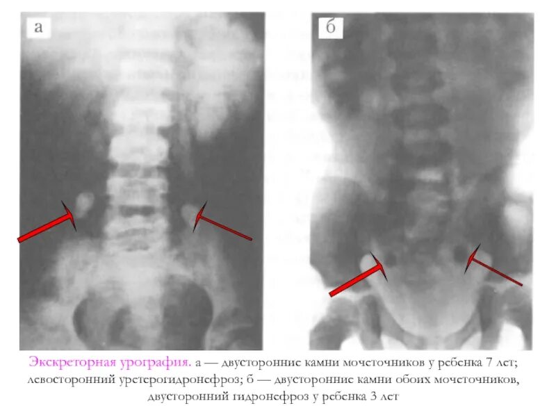 Обзорная урография камни в почках. Экскреторная урография при хроническом пиелонефрите. Мочекаменная болезнь экскреторная урография. Экскреторная урограмма обструктивный пиелонефрит. Обоих мочеточников