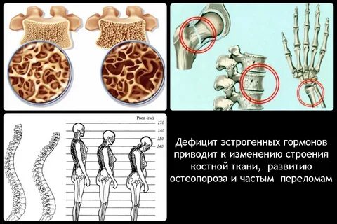 Остеопороз гормоны