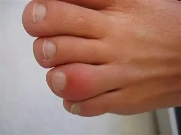 Pin on Toes and Feet