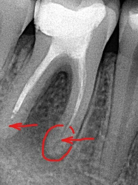Временное пломбирование каналов зуба. Фиброзный периодонтит рентгенограмма. Межкорневой периодонтит. Периапикальный периодонтит.